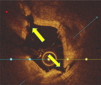 EXR_Clinical Evidence_Calcium Score 4_2