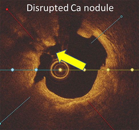 v2-cropped-EXR_Clinical-Evidence_Calcium-Score-2_2-1