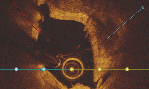 Intravascular Lithotripsy